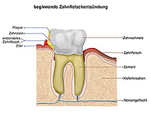 Zahnfleischentzündung - Parodontologie Zahnarzt Lassman Mannheim