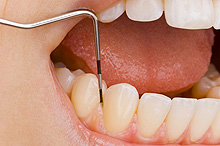 Parodontal-Behandlung - Prüfung der Taschentiefe - Zahnarzt A. Lassman Mannheim
