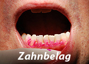 Zahnbelag wird bei der Prophylaxe durch Anfärben sichtbar gemacht - Zahnarztpraxis Lassman Mannheim