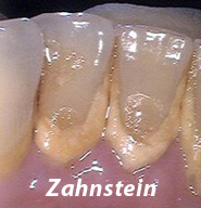 Professionelle Zahnreinigung - Zahnarztpraxis A. Lassman Mannheim Innenstadt