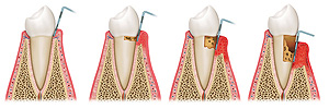 Parodontologie - Entwicklung von Parodontitis - Zahnarztpraxis Lassman Mannheim 