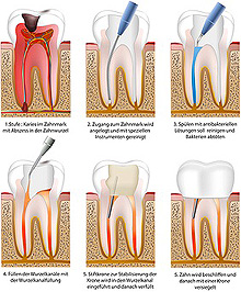 Wurzelkanalbehandlung (Endodontie) Zahnarztpraxis Lassman Mannheim